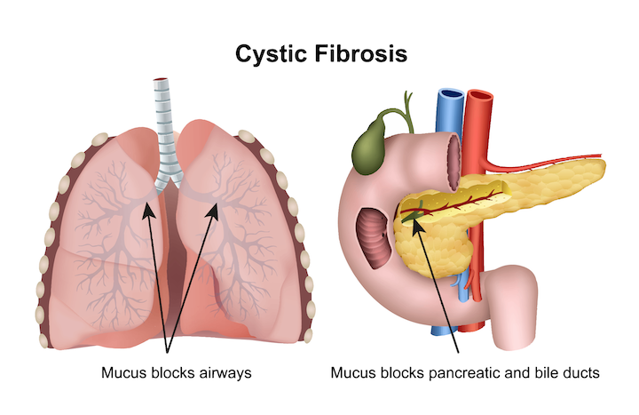 cystic-fibrosis-la-gi